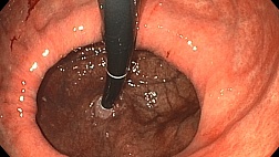 Гигантская фиксированная аксиальная грыжа без недостаточности кардиального жома.